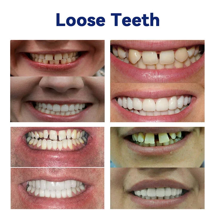 Bikendaā¢-š¦·Advanced Customized Full Denture Set𦷠(ā°Limited time discount last 30 minutesā°)