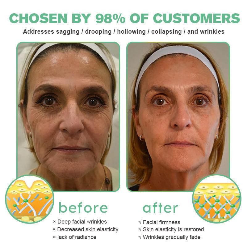FDA Approved✨𝓕𝓾𝓫𝓼𝓽𝓪™ Botox Bee Venom Wrinkle Removal Serum-Last Day Promotion 75% OFF👩⚕️✨