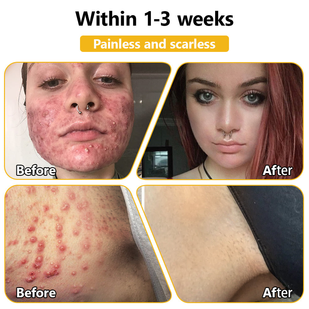 Tnnedey™ Bee Venom🐝 Skin Treatment Cream (AAD Recommended) ✨💆♀️ (Expert Recommended)