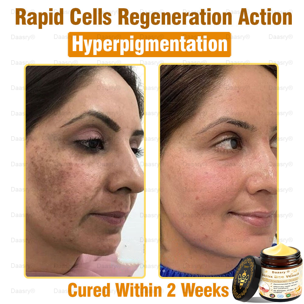 CVS Pharmacy: Daasry® Botox Bee Venom Skin Treatment Cream Approved by AAD