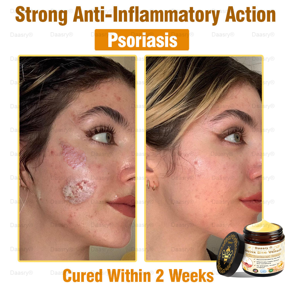 CVS Pharmacy: Daasry® Botox Bee Venom Skin Treatment Cream Approved by AAD