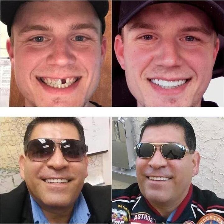Last Day Discount - 80% Off 💝Newest 2025👨⚕Adjustable Snap-On Dentures😁