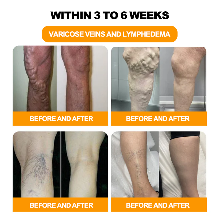 Tnnedey™ Bee Venom 𝐋𝐲𝐦𝐩𝐡𝐚𝐭𝐢𝐜 𝐃𝐫𝐚𝐢𝐧𝐚𝐠𝐞 & 𝐒𝐥𝐢𝐦𝐦𝐢𝐧𝐠 Foot Patches - 𝐓𝐚𝐫𝐠𝐞𝐭 𝐒𝐰𝐞𝐥𝐥𝐢𝐧𝐠 & 𝐃𝐞𝐭𝐨𝐱 𝐍𝐚𝐭𝐮𝐫𝐚𝐥𝐥𝐲🌿👣