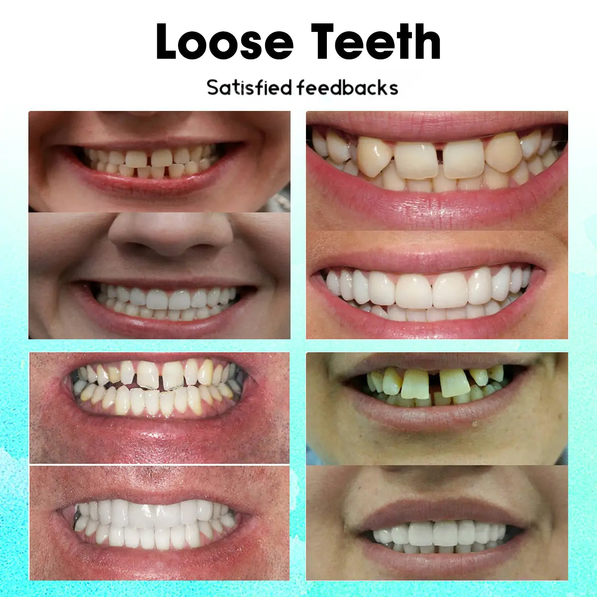 𝐋𝐚𝐬𝐭 𝐃𝐚𝐲 𝐃𝐢𝐬𝐜𝐨𝐮𝐧𝐭 - 𝟕𝟓% 𝐎𝐟𝐟 🎊Newest 2025 𝐓𝐧𝐧𝐞𝐝𝐞𝐲® Adjustable Snap-On Dentures✅🦷