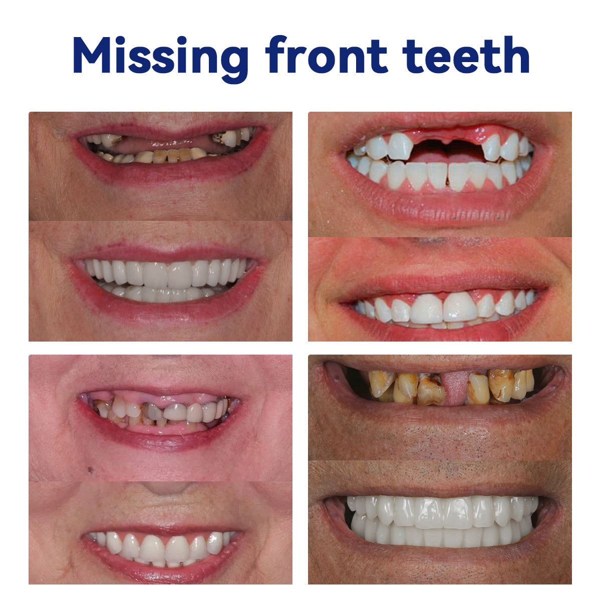 Bikenda™ Silicone Denture Ruler Set (👩‍🔬 CED Compliant Approved By Professional Dentists)