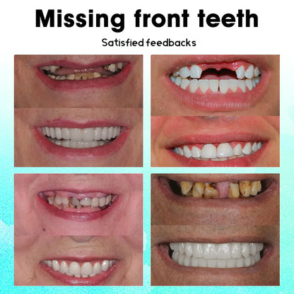 𝐋𝐚𝐬𝐭 𝐃𝐚𝐲 𝐃𝐢𝐬𝐜𝐨𝐮𝐧𝐭 - 𝟕𝟓% 𝐎𝐟𝐟 🎊Newest 2025 𝐓𝐧𝐧𝐞𝐝𝐞𝐲® Adjustable Snap-On Dentures✅🦷