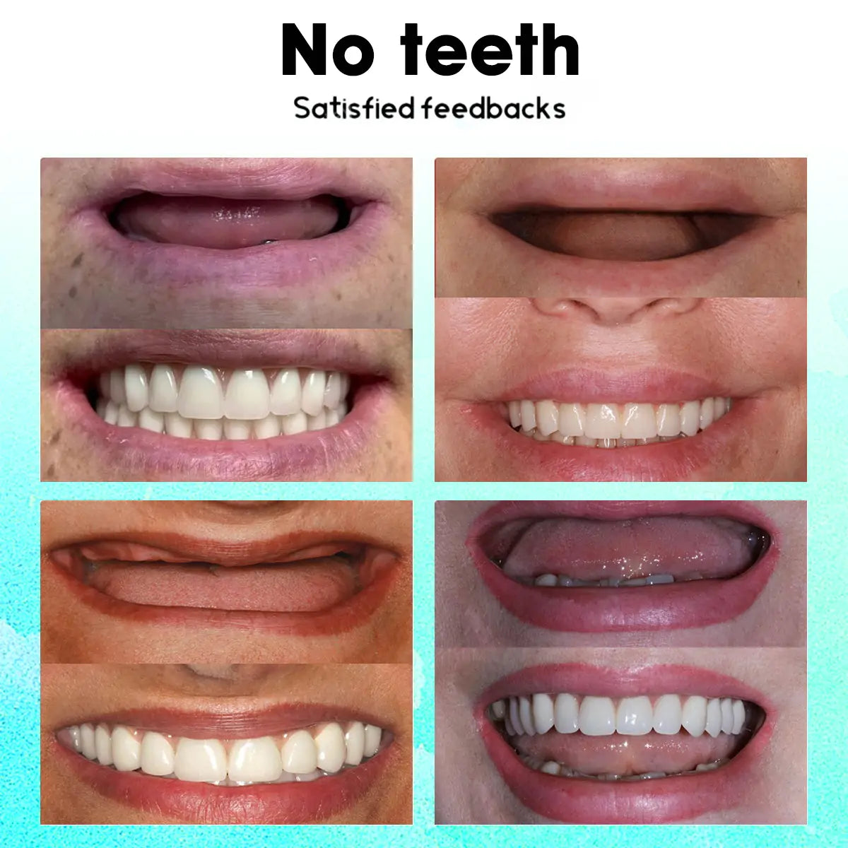 𝐋𝐚𝐬𝐭 𝐃𝐚𝐲 𝐃𝐢𝐬𝐜𝐨𝐮𝐧𝐭 - 𝟕𝟓% 𝐎𝐟𝐟 🎊Newest 2025 𝐓𝐧𝐧𝐞𝐝𝐞𝐲® Adjustable Snap-On Dentures✅🦷