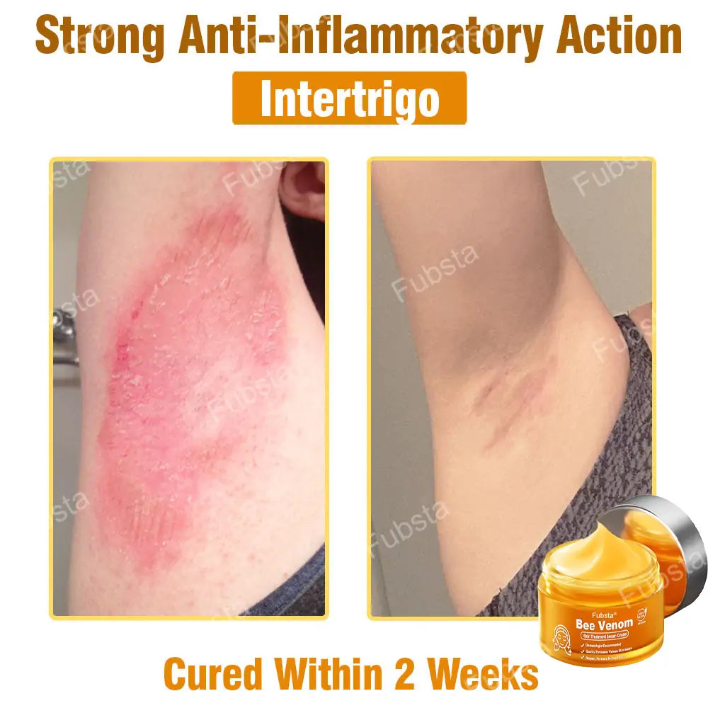 Fubsta® 𝑩𝒆𝒆 𝑽𝒆𝒏𝒐𝒎 𝑺𝒌𝒊𝒏 𝑻𝒓𝒆𝒂𝒕𝒎𝒆𝒏𝒕 𝑺𝒆𝒓𝒖𝒎 𝑪𝒓𝒆𝒂𝒎👨‍⚕️ (Suitable for all ages & TGA recommends)