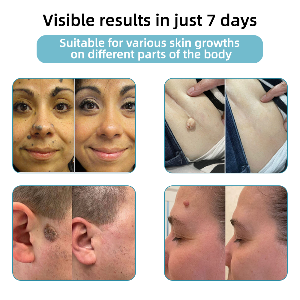 Clinically Reviewed by Mayo Clinic Experts: 👩‍⚕️Mresio® 𝑵on-i𝒏va𝒔𝒊ve 𝑴o𝒍e an𝒅 𝑾ar𝒕 𝑹emo𝒗𝒂𝒍 𝑳ase𝒓 𝑷en 𝑷roma𝒙 (Fast and painless removal of warts. moles. age spots. and skin tags — completely without side effects.)🚀