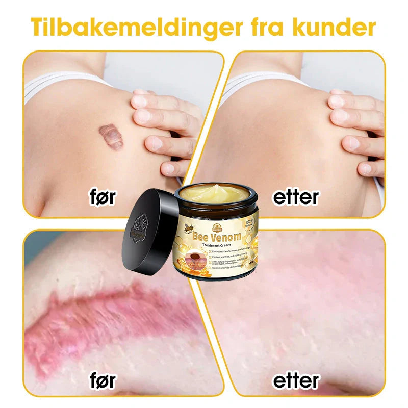 [Offisiell nettside] 𝐓𝐧𝐧𝐞𝐝𝐞𝐲®  Biegift Hudbehandlingskrem er godkjent av NFDV (Hjelper mot akne, vorter, rosacea, psoriasis, aldersflekker, eksem og reduserer synligheten av strekkmerker)🌿