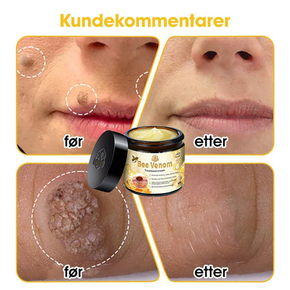 [Offisiell nettside] 𝐓𝐧𝐧𝐞𝐝𝐞𝐲®  Biegift Hudbehandlingskrem er godkjent av NFDV (Hjelper mot akne, vorter, rosacea, psoriasis, aldersflekker, eksem og reduserer synligheten av strekkmerker)🌿