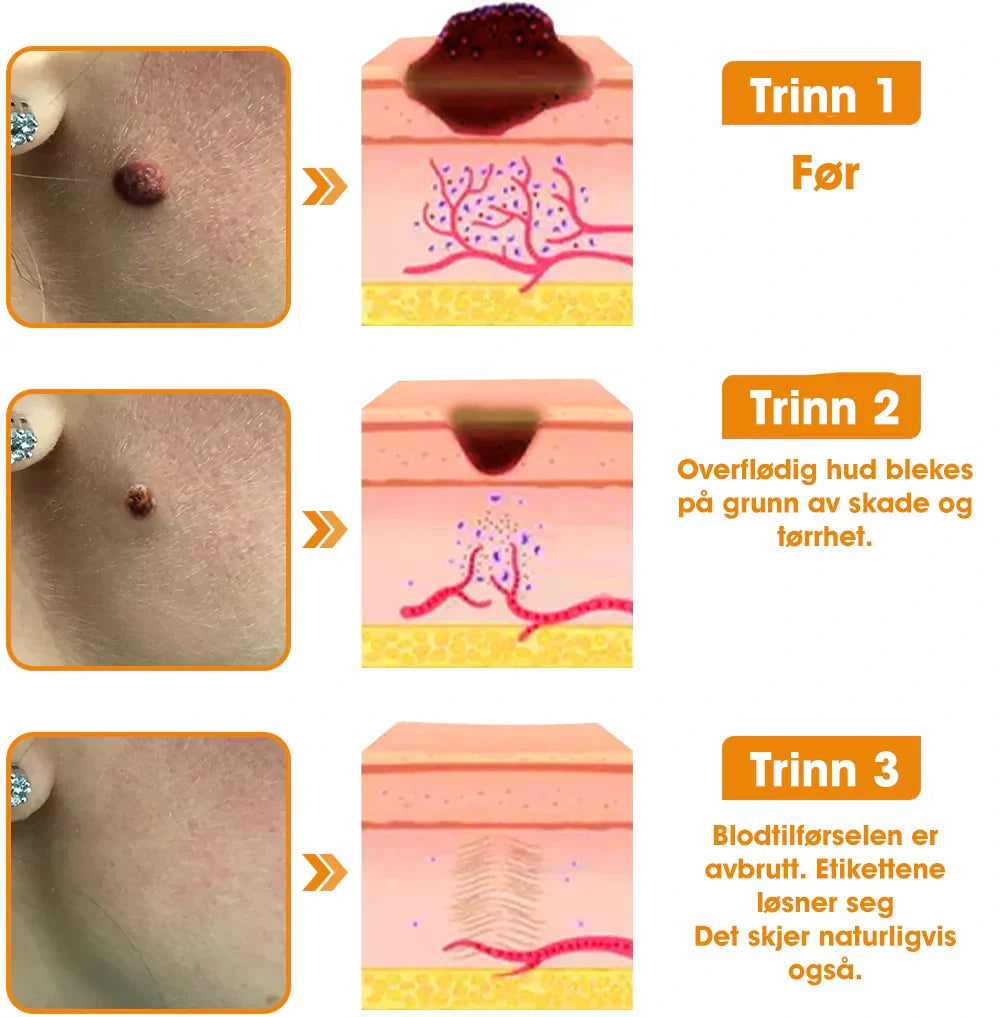 [Offisiell nettside] 𝐓𝐧𝐧𝐞𝐝𝐞𝐲®  Biegift Hudbehandlingskrem er godkjent av NFDV (Hjelper mot akne, vorter, rosacea, psoriasis, aldersflekker, eksem og reduserer synligheten av strekkmerker)🌿