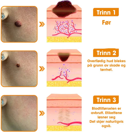 [Offisiell nettside] 𝐓𝐧𝐧𝐞𝐝𝐞𝐲®  Biegift Hudbehandlingskrem er godkjent av NFDV (Hjelper mot akne, vorter, rosacea, psoriasis, aldersflekker, eksem og reduserer synligheten av strekkmerker)🌿