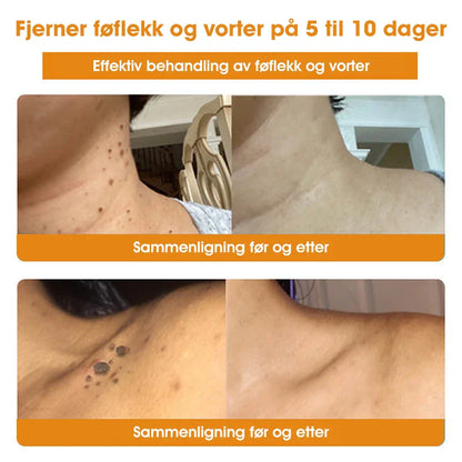 [Offisiell nettside] 𝐓𝐧𝐧𝐞𝐝𝐞𝐲®  Biegift Hudbehandlingskrem er godkjent av NFDV (Hjelper mot akne, vorter, rosacea, psoriasis, aldersflekker, eksem og reduserer synligheten av strekkmerker)🌿