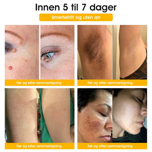 [Offisiell nettside] 𝐓𝐧𝐧𝐞𝐝𝐞𝐲®  Biegift Hudbehandlingskrem er godkjent av NFDV (Hjelper mot akne, vorter, rosacea, psoriasis, aldersflekker, eksem og reduserer synligheten av strekkmerker)🌿