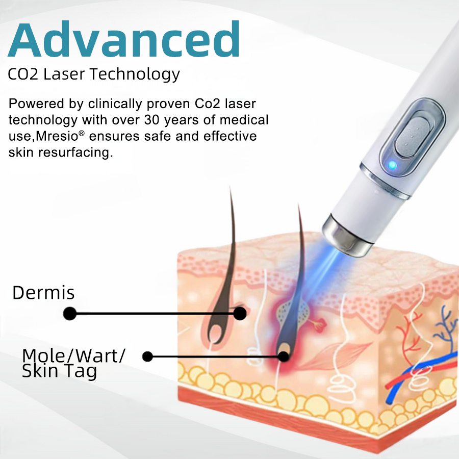 Clinically Reviewed by Mayo Clinic Experts: 👩‍⚕️Mresio® 𝑵on-i𝒏va𝒔𝒊ve 𝑴o𝒍e an𝒅 𝑾ar𝒕 𝑹emo𝒗𝒂𝒍 𝑳ase𝒓 𝑷en 𝑷roma𝒙 (Fast and painless removal of warts. moles. age spots. and skin tags — completely without side effects.)🚀