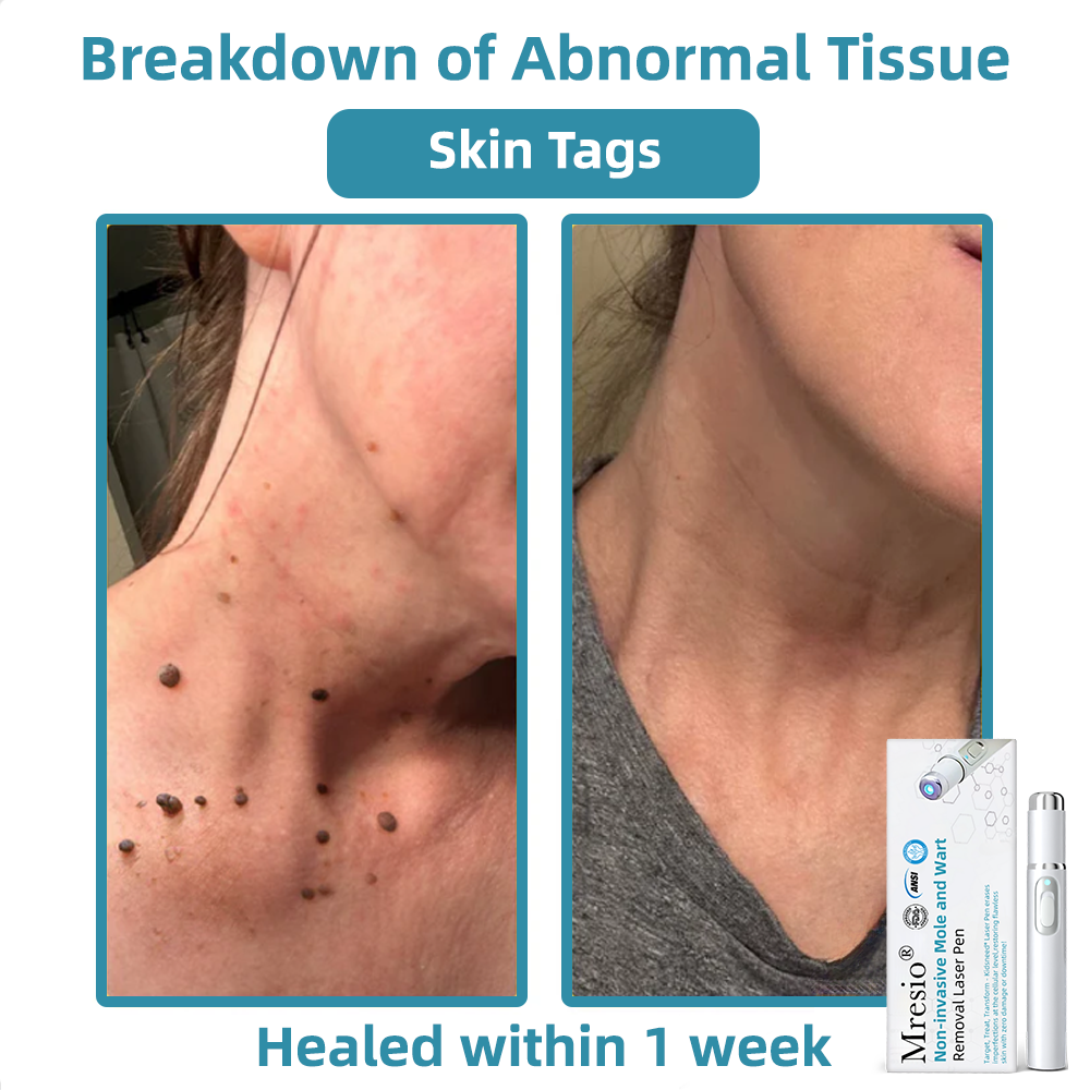 Clinically Reviewed by Mayo Clinic Experts: 👩‍⚕️Mresio® 𝑵on-i𝒏va𝒔𝒊ve 𝑴o𝒍e an𝒅 𝑾ar𝒕 𝑹emo𝒗𝒂𝒍 𝑳ase𝒓 𝑷en 𝑷roma𝒙 (Fast and painless removal of warts. moles. age spots. and skin tags — completely without side effects.)🚀
