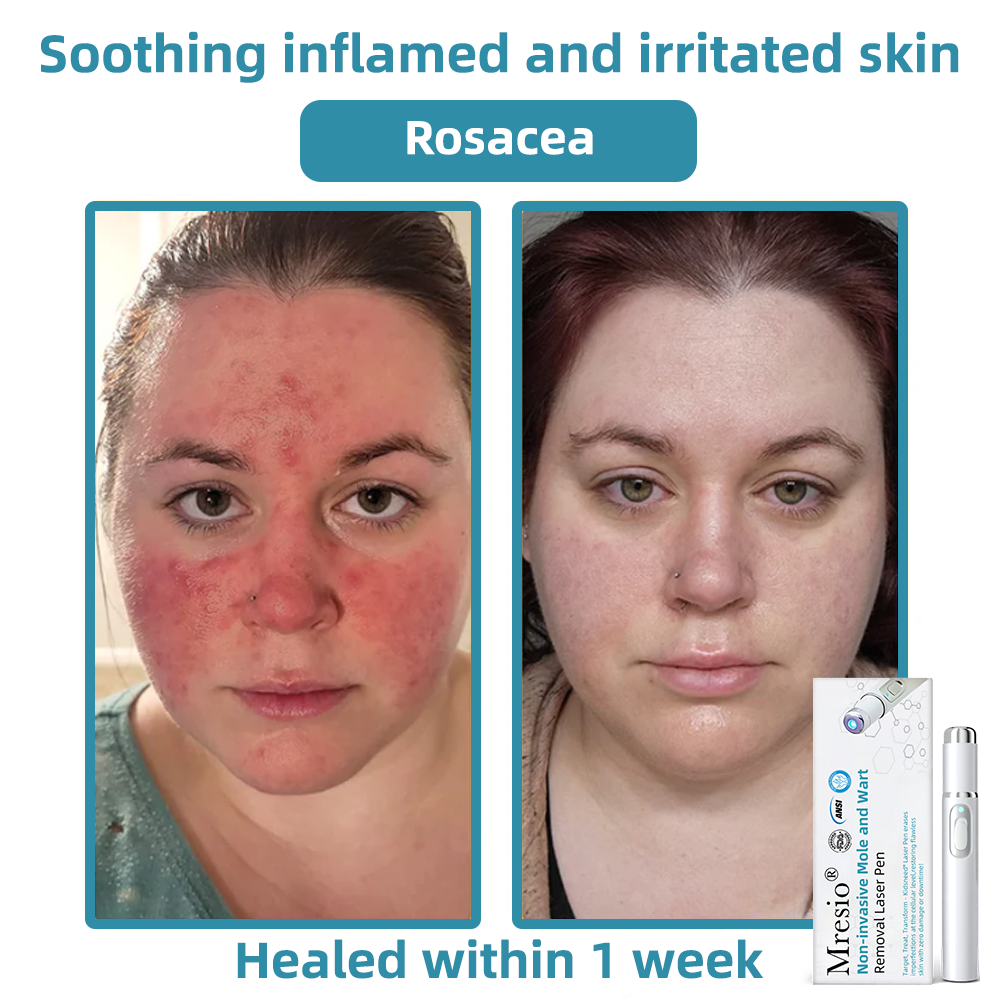 Clinically Reviewed by Mayo Clinic Experts: 👩‍⚕️Mresio® 𝑵on-i𝒏va𝒔𝒊ve 𝑴o𝒍e an𝒅 𝑾ar𝒕 𝑹emo𝒗𝒂𝒍 𝑳ase𝒓 𝑷en 𝑷roma𝒙 (Fast and painless removal of warts. moles. age spots. and skin tags — completely without side effects.)🚀