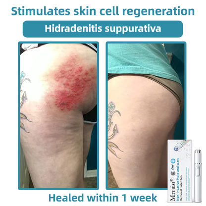 Clinically Reviewed by Mayo Clinic Experts: 👩‍⚕️Mresio® 𝑵on-i𝒏va𝒔𝒊ve 𝑴o𝒍e an𝒅 𝑾ar𝒕 𝑹emo𝒗𝒂𝒍 𝑳ase𝒓 𝑷en 𝑷roma𝒙 (Fast and painless removal of warts. moles. age spots. and skin tags — completely without side effects.)🚀