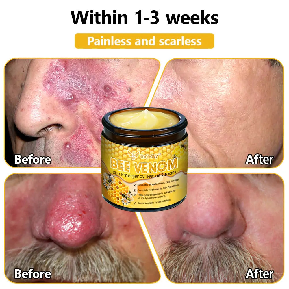 Tnnedey™ Bee Venom Skin Emergency Rescue Cream (AAD Recommended) 💆‍♀️ Expert Recommended for Ultimate Skin Revival ✨