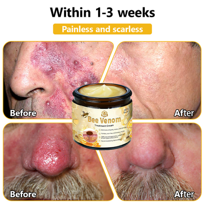 Tnnedey™ Bee Venom🐝 Skin Treatment Cream (AAD Recommended) ✨💆‍♀️ (Expert Recommended)