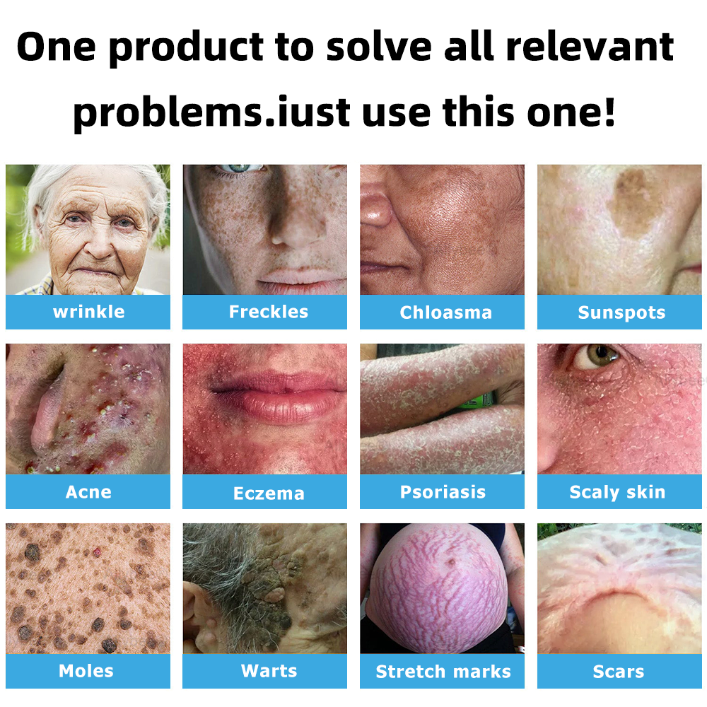 Clinically Reviewed by Mayo Clinic Experts: 👩‍⚕️Mresio® 𝑵on-i𝒏va𝒔𝒊ve 𝑴o𝒍e an𝒅 𝑾ar𝒕 𝑹emo𝒗𝒂𝒍 𝑳ase𝒓 𝑷en 𝑷roma𝒙 (Fast and painless removal of warts. moles. age spots. and skin tags — completely without side effects.)🚀