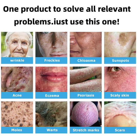 Clinically Reviewed by Mayo Clinic Experts: 👩‍⚕️Mresio® 𝑵on-i𝒏va𝒔𝒊ve 𝑴o𝒍e an𝒅 𝑾ar𝒕 𝑹emo𝒗𝒂𝒍 𝑳ase𝒓 𝑷en 𝑷roma𝒙 (Fast and painless removal of warts. moles. age spots. and skin tags — completely without side effects.)🚀