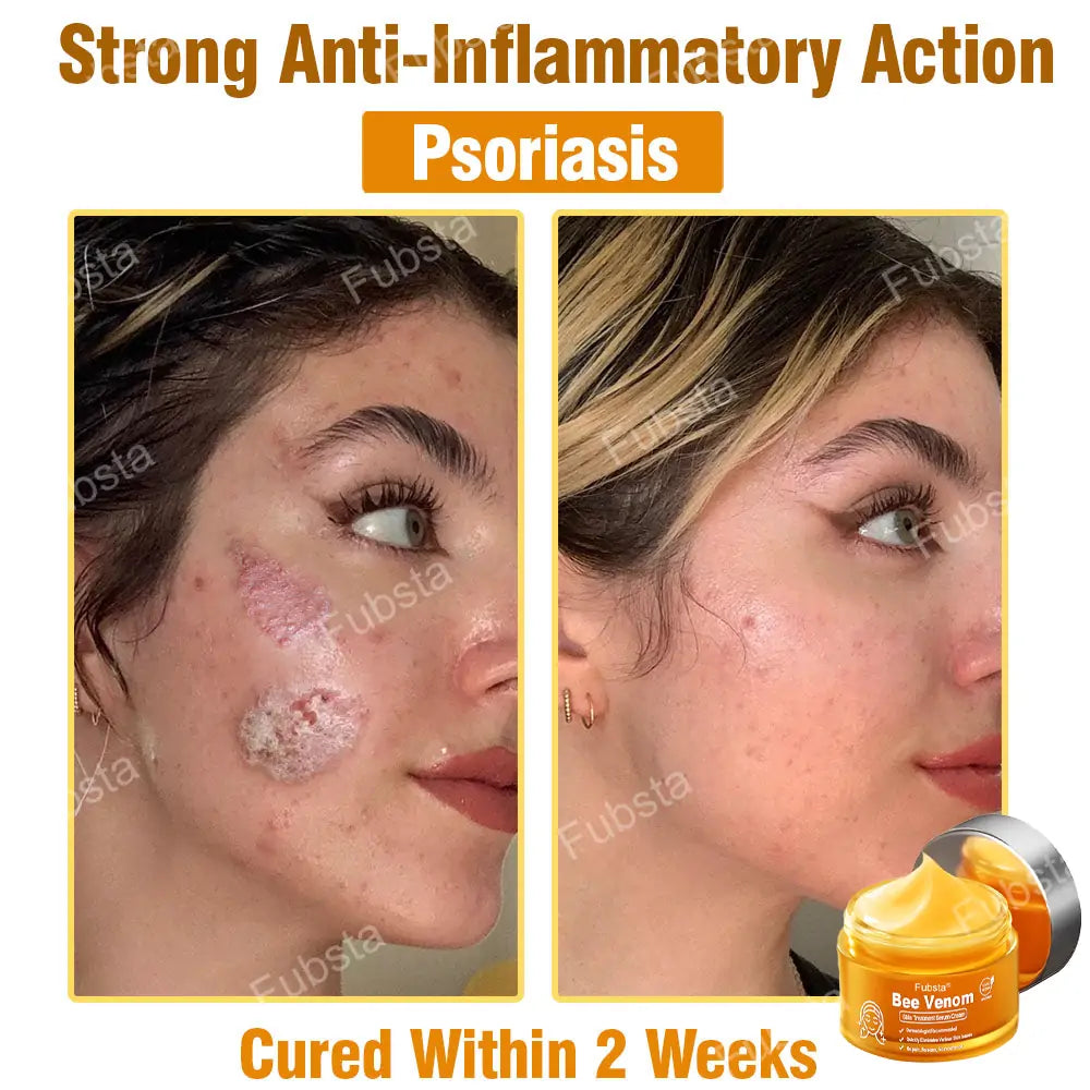 Fubsta® 𝑩𝒆𝒆 𝑽𝒆𝒏𝒐𝒎 𝑺𝒌𝒊𝒏 𝑻𝒓𝒆𝒂𝒕𝒎𝒆𝒏𝒕 𝑺𝒆𝒓𝒖𝒎 𝑪𝒓𝒆𝒂𝒎👨‍⚕️ (Suitable for all ages & TGA recommends)