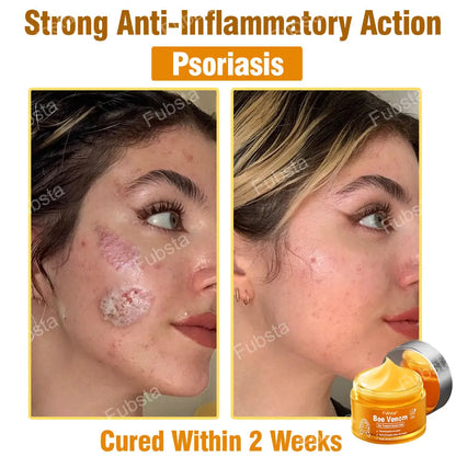 Fubsta® 𝑩𝒆𝒆 𝑽𝒆𝒏𝒐𝒎 𝑺𝒌𝒊𝒏 𝑻𝒓𝒆𝒂𝒕𝒎𝒆𝒏𝒕 𝑺𝒆𝒓𝒖𝒎 𝑪𝒓𝒆𝒂𝒎👨‍⚕️ (Suitable for all ages & TGA recommends)