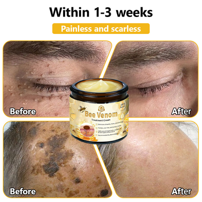 Tnnedey™ Bee Venom🐝 Skin Treatment Cream (AAD Recommended) ✨💆‍♀️ (Expert Recommended)