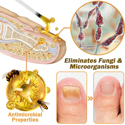 𝐓𝐧𝐧𝐞𝐝𝐞𝐲® Bee Venom Toenail Fungus Treatment Solution🐝💅 - Say Goodbye to Nail Fungus✨