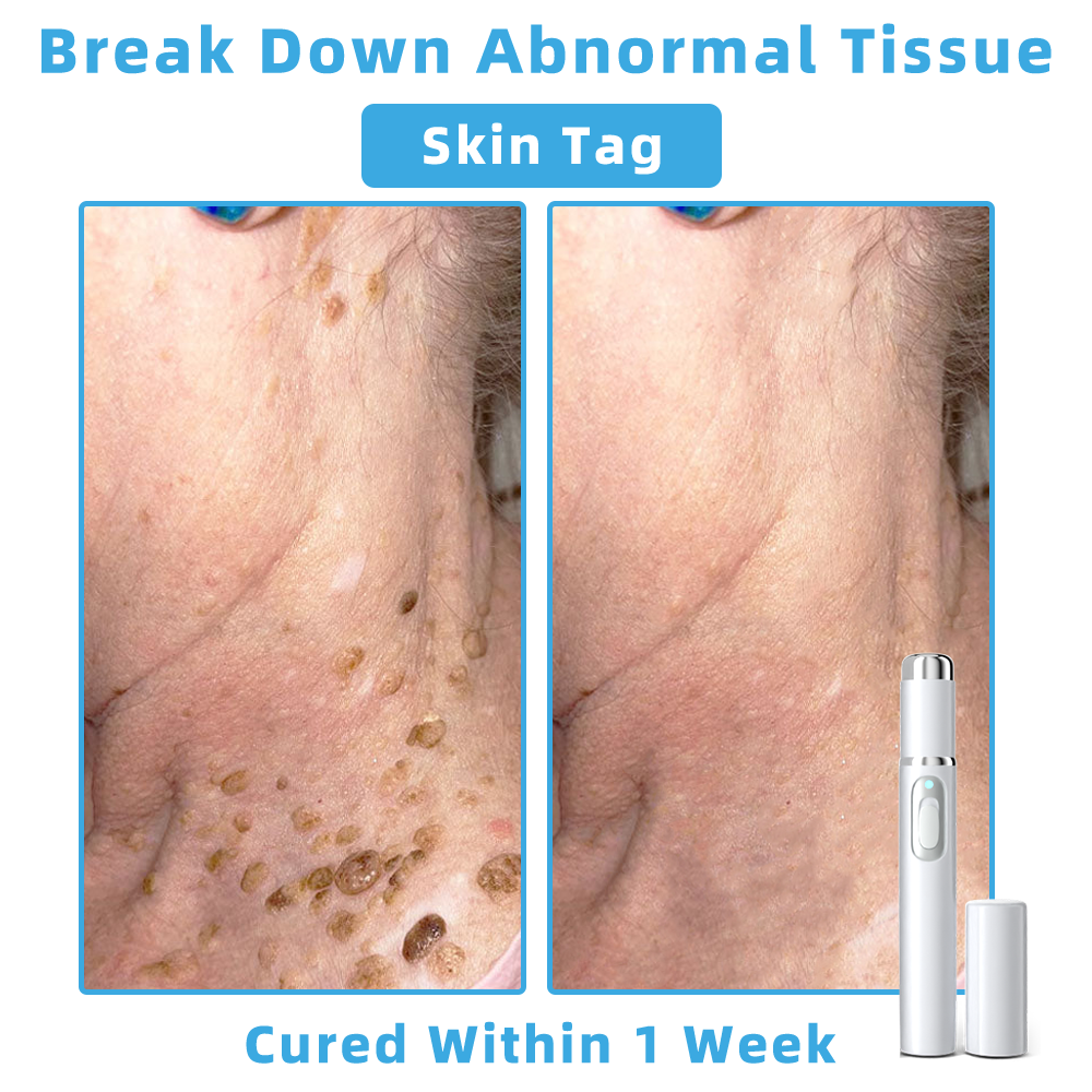 Clinically Reviewed by Mayo Clinic Experts: 👩‍⚕️Mresio® 𝑵on-i𝒏va𝒔𝒊ve 𝑴o𝒍e an𝒅 𝑾ar𝒕 𝑹emo𝒗𝒂𝒍 𝑳ase𝒓 𝑷en 𝑷roma𝒙 (Fast and painless removal of warts. moles. age spots. and skin tags — completely without side effects.)🚀