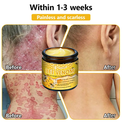 Tnnedey™ Bee Venom Skin Emergency Rescue Cream (AAD Recommended) 💆‍♀️ Expert Recommended for Ultimate Skin Revival ✨