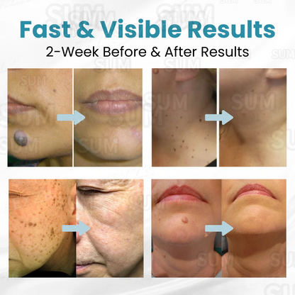 ✨Bikenda®Non-Invasive Skin Imperfection Removal Pen✨