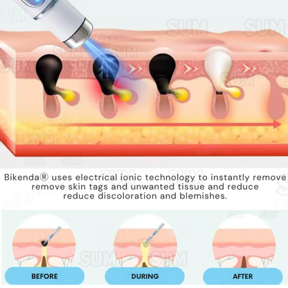 ✨Bikenda® Neinvazivní Tužka na Odstranění Kožních Nedokonalostí✨
