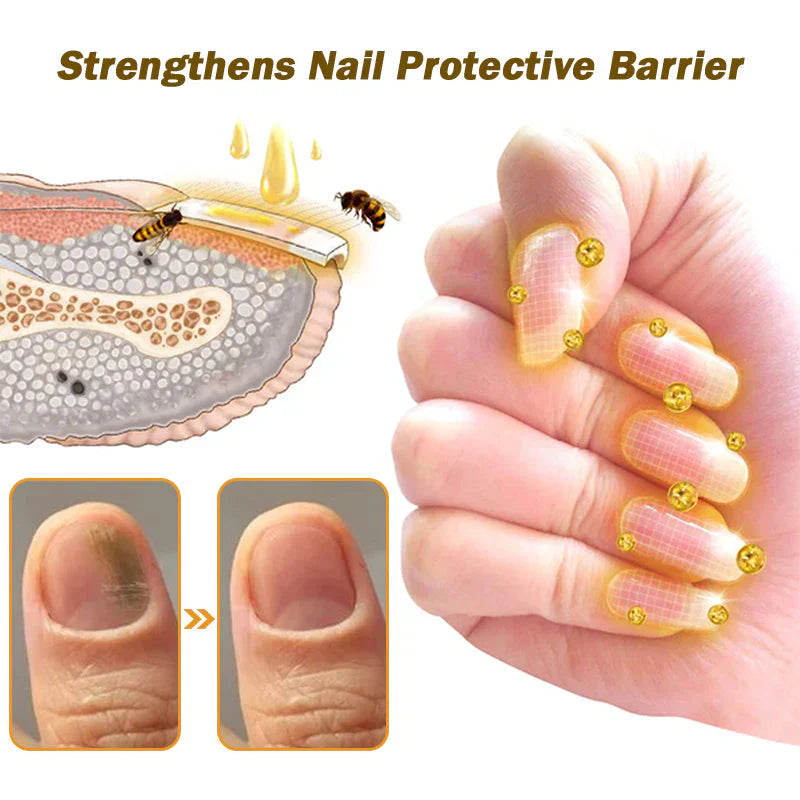 𝐓𝐧𝐧𝐞𝐝𝐞𝐲® Bee Venom Toenail Fungus Treatment Solution🐝💅 - Say Goodbye to Nail Fungus✨