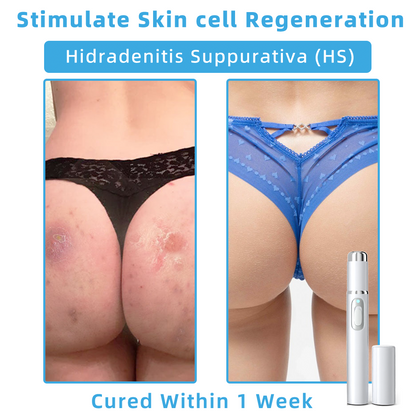 Clinically Reviewed by Mayo Clinic Experts: 👩‍⚕️Mresio® 𝑵on-i𝒏va𝒔𝒊ve 𝑴o𝒍e an𝒅 𝑾ar𝒕 𝑹emo𝒗𝒂𝒍 𝑳ase𝒓 𝑷en 𝑷roma𝒙 (Fast and painless removal of warts. moles. age spots. and skin tags — completely without side effects.)🚀