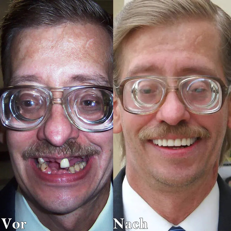 Last Day Discount - 80% Off 💝Newest 2025👨‍⚕Adjustable Snap-On Dentures😁