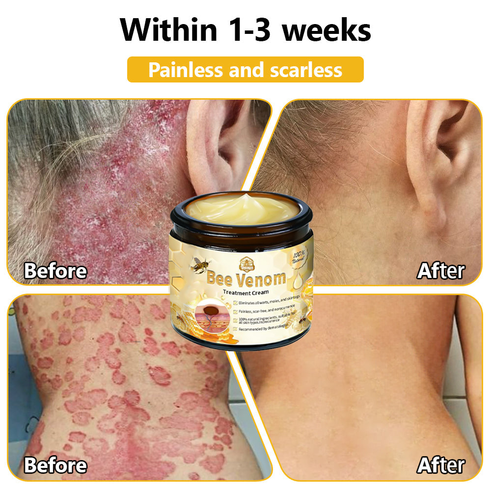 Tnnedey™ Bee Venom🐝 Skin Treatment Cream (AAD Recommended) ✨💆‍♀️ (Expert Recommended)