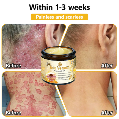 Tnnedey™ Bee Venom🐝 Skin Treatment Cream (AAD Recommended) ✨💆‍♀️ (Expert Recommended)