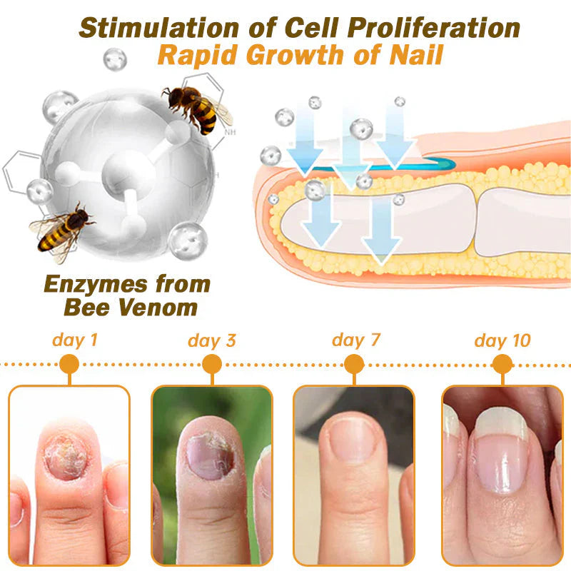 𝐓𝐧𝐧𝐞𝐝𝐞𝐲® Bee Venom Toenail Fungus Treatment Solution🐝💅 - Say Goodbye to Nail Fungus✨
