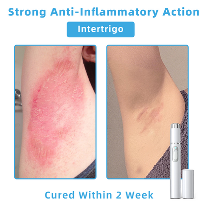 Clinically Reviewed by Mayo Clinic Experts: 👩‍⚕️Mresio® 𝑵on-i𝒏va𝒔𝒊ve 𝑴o𝒍e an𝒅 𝑾ar𝒕 𝑹emo𝒗𝒂𝒍 𝑳ase𝒓 𝑷en 𝑷roma𝒙 (Fast and painless removal of warts. moles. age spots. and skin tags — completely without side effects.)🚀