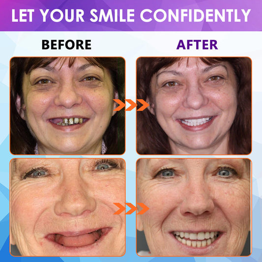 𝐁𝐢𝐤𝐞𝐧𝐝𝐚™ 𝐒𝐢𝐥𝐢𝐜𝐨𝐧𝐞 𝐑𝐞𝐥𝐢𝐧𝐞 𝐃𝐞𝐧𝐭𝐮𝐫𝐞 𝐒𝐞𝐭 (⏰ 𝐋𝐢𝐦𝐢𝐭𝐞𝐝 𝐓𝐢𝐦𝐞 𝐃𝐢𝐬𝐜𝐨𝐮𝐧𝐭 𝐋𝐚𝐬𝐭 𝟒𝟎 𝐌𝐢𝐧𝐮𝐭𝐞𝐬 ⏰) 🦷✨ - Health Canada Certified✅