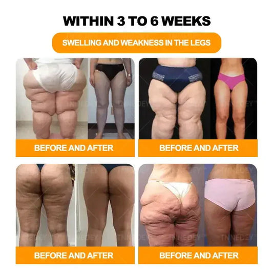 𝐋𝐚𝐬𝐭 𝐝𝐚𝐲 𝐭𝐨 𝐠𝐞𝐭 𝟕𝟎% 𝐎𝐅𝐅: 𝐓𝐧𝐧𝐞𝐝𝐞𝐲® 𝐁𝐞𝐞 𝐕𝐞𝐧𝐨𝐦 & 𝟑𝟎-𝐇𝐞𝐫𝐛 𝐃𝐞𝐭𝐨𝐱 𝐅𝐨𝐨𝐭 𝐒𝐨𝐚𝐤 𝐁𝐞𝐚𝐝𝐬 𝐟𝐨𝐫 𝐁𝐨𝐝𝐲 𝐒𝐜𝐮𝐥𝐩𝐭𝐢𝐧𝐠- Recommended by the America Lymphatic Academy (ALA) ⚡🏆