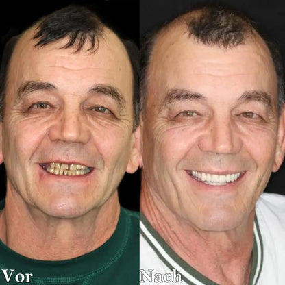 Last Day Discount - 80% Off 😁Newest 2025👨‍⚕Adjustable Snap-On Dentures💝