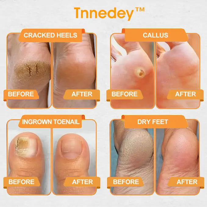 Tnnedey™ Bee Venom 𝐋𝐲𝐦𝐩𝐡𝐚𝐭𝐢𝐜 𝐃𝐫𝐚𝐢𝐧𝐚𝐠𝐞 & 𝐒𝐥𝐢𝐦𝐦𝐢𝐧𝐠 Foot Patches - 𝐓𝐚𝐫𝐠𝐞𝐭 𝐒𝐰𝐞𝐥𝐥𝐢𝐧𝐠 & 𝐃𝐞𝐭𝐨𝐱 𝐍𝐚𝐭𝐮𝐫𝐚𝐥𝐥𝐲🌿👣
