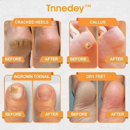 Tnnedey™ Bee Venom 𝐋𝐲𝐦𝐩𝐡𝐚𝐭𝐢𝐜 𝐃𝐫𝐚𝐢𝐧𝐚𝐠𝐞 & 𝐒𝐥𝐢𝐦𝐦𝐢𝐧𝐠 Foot Patches - 𝐓𝐚𝐫𝐠𝐞𝐭 𝐒𝐰𝐞𝐥𝐥𝐢𝐧𝐠 & 𝐃𝐞𝐭𝐨𝐱 𝐍𝐚𝐭𝐮𝐫𝐚𝐥𝐥𝐲🌿👣