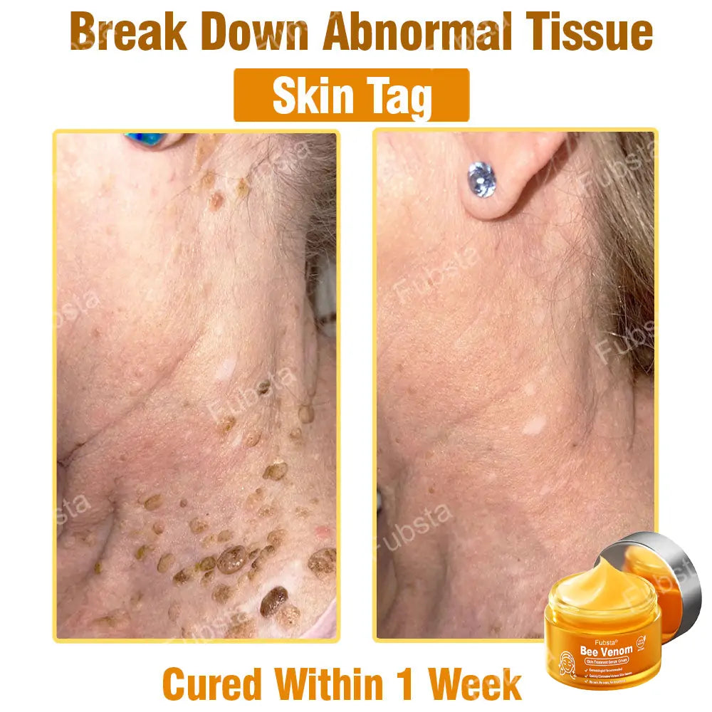 Fubsta® 𝑩𝒆𝒆 𝑽𝒆𝒏𝒐𝒎 𝑺𝒌𝒊𝒏 𝑻𝒓𝒆𝒂𝒕𝒎𝒆𝒏𝒕 𝑺𝒆𝒓𝒖𝒎 𝑪𝒓𝒆𝒂𝒎👨‍⚕️ (Suitable for all ages & TGA recommends)