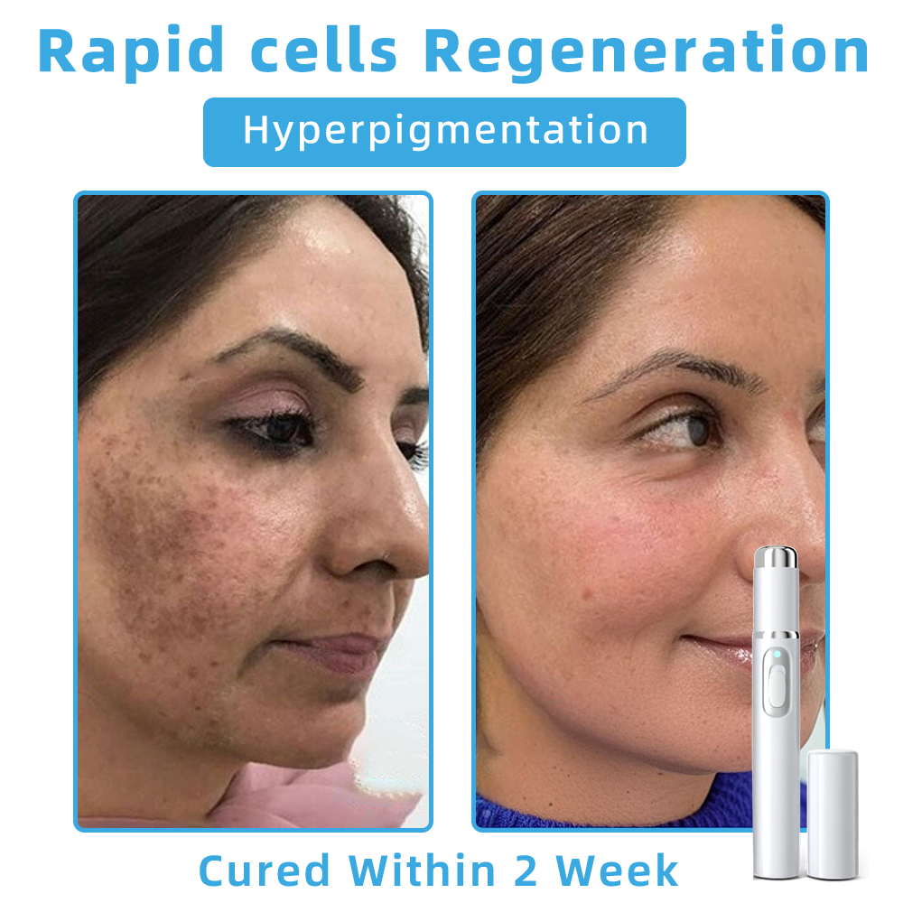 Clinically Reviewed by Mayo Clinic Experts: 👩‍⚕️Mresio® 𝑵on-i𝒏va𝒔𝒊ve 𝑴o𝒍e an𝒅 𝑾ar𝒕 𝑹emo𝒗𝒂𝒍 𝑳ase𝒓 𝑷en 𝑷roma𝒙 (Fast and painless removal of warts. moles. age spots. and skin tags — completely without side effects.)🚀