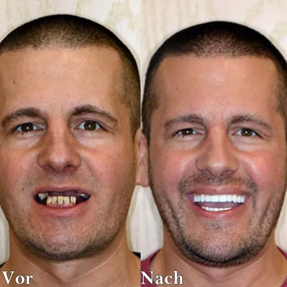 Last Day Discount - 80% Off 😁Newest 2025👨‍⚕Adjustable Snap-On Dentures💝